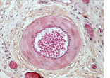 Les cellules endothéliales en apoptose ont pu être visualisées à l'aide de la technique Tunel (en vert) associée au marquage CD31 (en rouge) spécifique des cellules endothéliales. Les cellules endothéliales en apoptose présentent à la fois le marquage ver