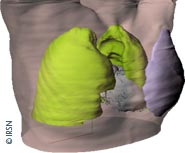 Fantôme numérique hybride d’un thorax féminin (vert=poumons ; violet=glande mammaire gauche) avec le modèle détaillé de cœur (gris).