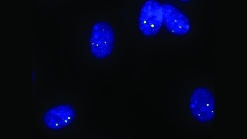 Cellules irradiées par un rayonnement gamma présentant des foci
